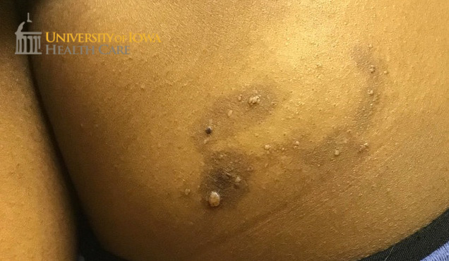Brown patch with overlying smooth skin-colored papules. (click images for higher resolution).